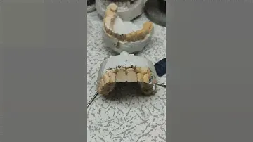 Металлокерамика Зубов